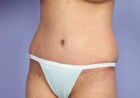 Tummy Tuck Before & After Image