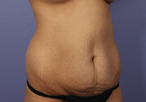 Tummy Tuck Before & After Image