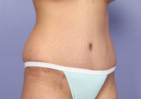 Tummy Tuck Before & After Image