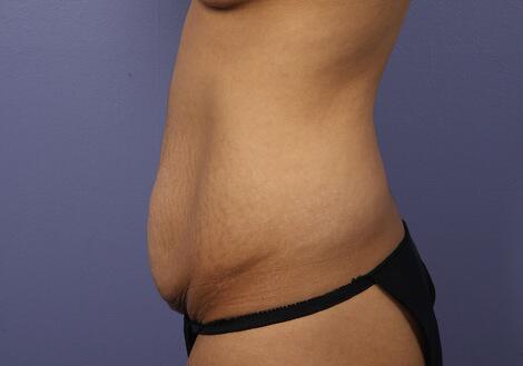 Tummy Tuck Before & After Image