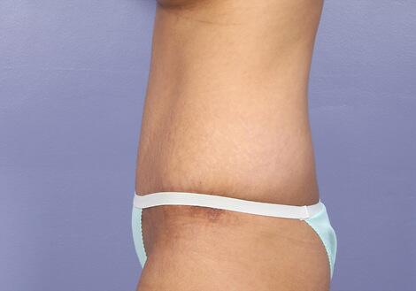 Tummy Tuck Before & After Image