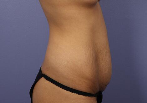 Tummy Tuck Before & After Image