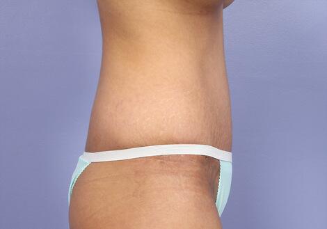 Tummy Tuck Before & After Image