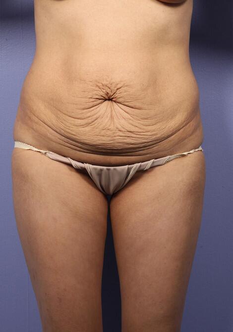 Tummy Tuck Before & After Image