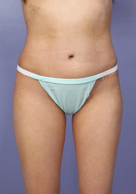 Tummy Tuck Before & After Image