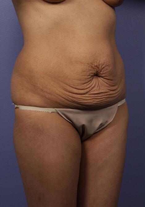 Tummy Tuck Before & After Image