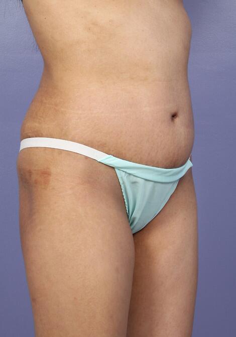 Tummy Tuck Before & After Image