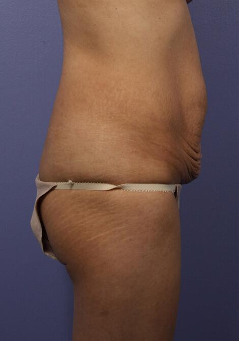 Tummy Tuck Before & After Image