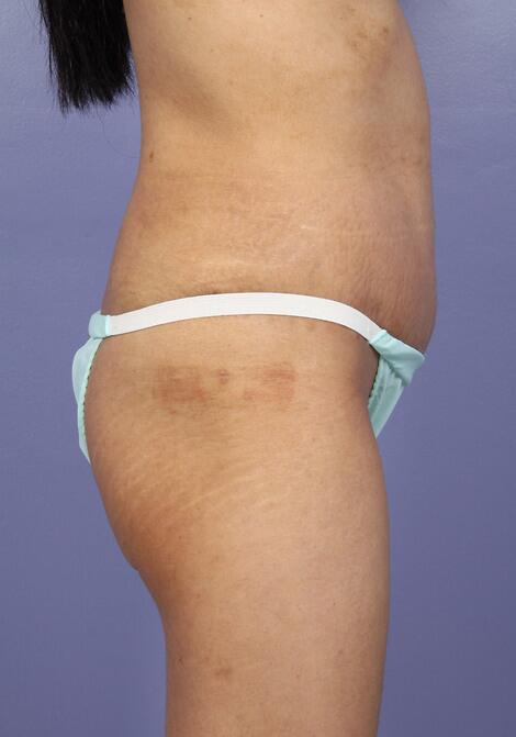 Tummy Tuck Before & After Image