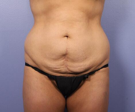 Tummy Tuck Before & After Image