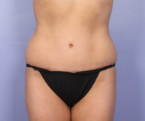 Tummy Tuck Before & After Image