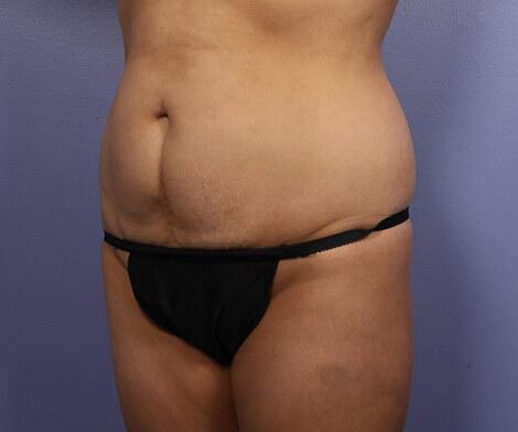 Tummy Tuck Before & After Image