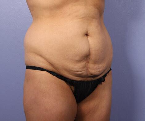 Tummy Tuck Before & After Image