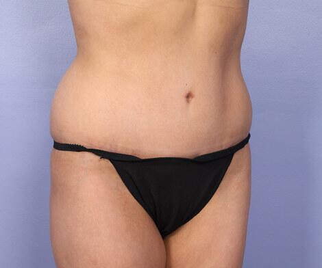 Tummy Tuck Before & After Image