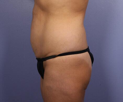 Tummy Tuck Before & After Image