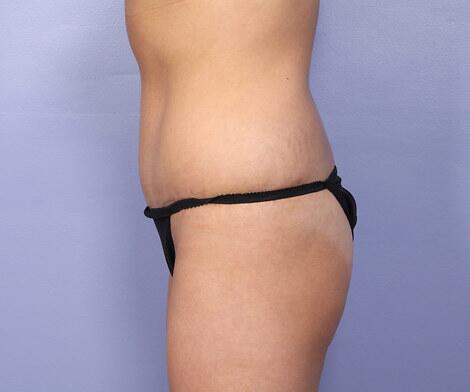 Tummy Tuck Before & After Image