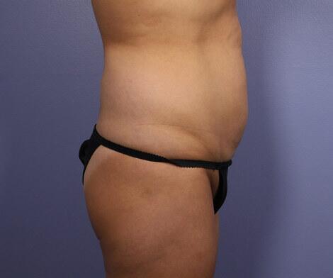 Tummy Tuck Before & After Image