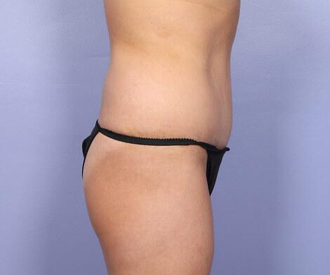 Tummy Tuck Before & After Image