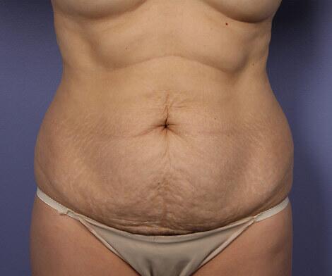 Tummy Tuck Before & After Image