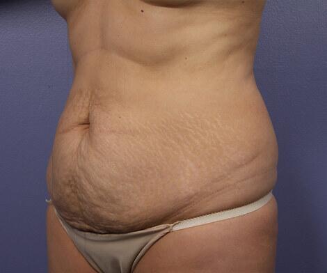 Tummy Tuck Before & After Image