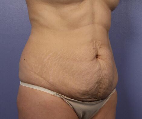 Tummy Tuck Before & After Image