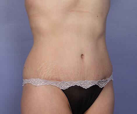 Tummy Tuck Before & After Image