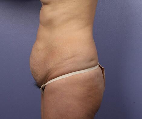 Tummy Tuck Before & After Image