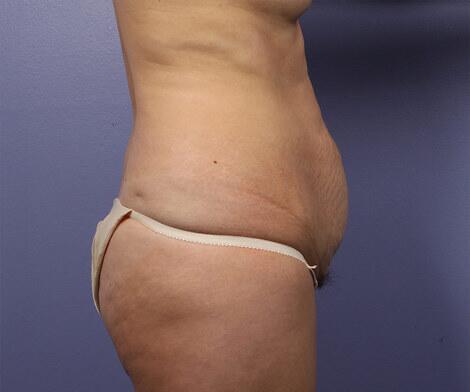 Tummy Tuck Before & After Image