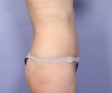 Tummy Tuck Before & After Image