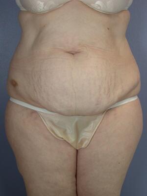 Tummy Tuck Before & After Image