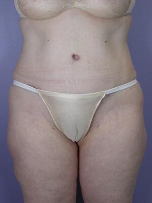 Tummy Tuck Before & After Image