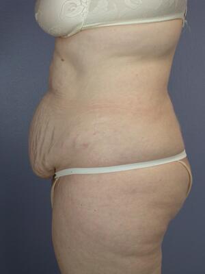 Tummy Tuck Before & After Image