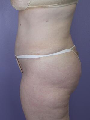 Tummy Tuck Before & After Image