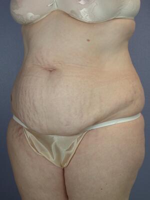 Tummy Tuck Before & After Image