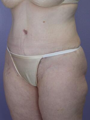 Tummy Tuck Before & After Image