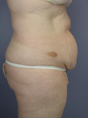 Tummy Tuck Before & After Image