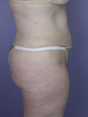 Tummy Tuck Before & After Image