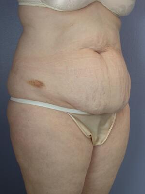 Tummy Tuck Before & After Image