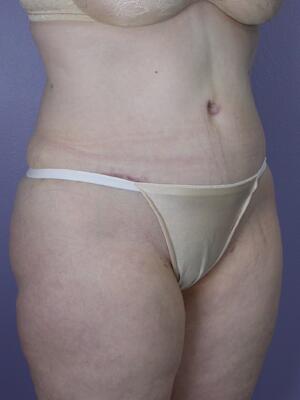 Tummy Tuck Before & After Image