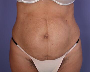 Tummy Tuck Before & After Image