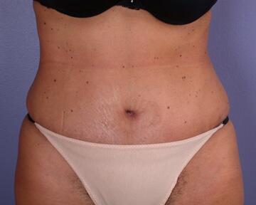 Tummy Tuck Before & After Image