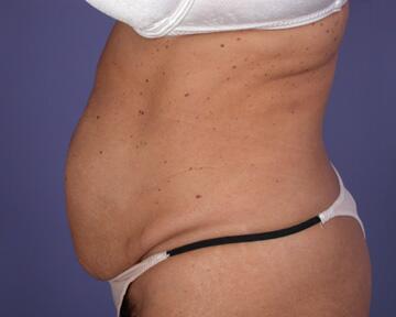 Tummy Tuck Before & After Image