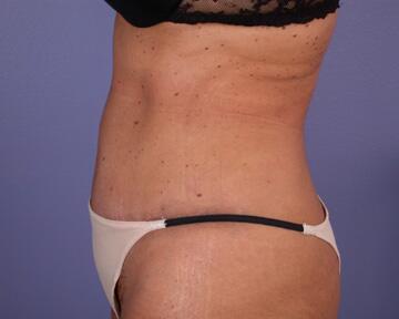 Tummy Tuck Before & After Image