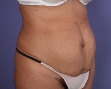 Tummy Tuck Before & After Image