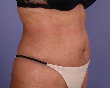 Tummy Tuck Before & After Image