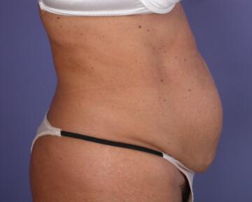 Tummy Tuck Before & After Image