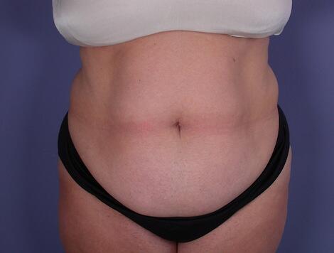 Tummy Tuck Before & After Image