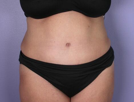 Tummy Tuck Before & After Image