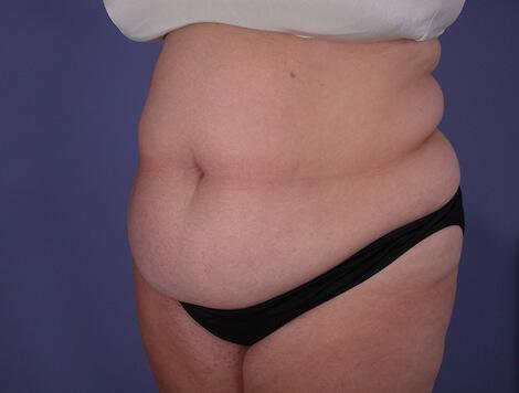 Tummy Tuck Before & After Image