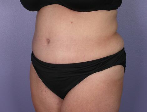 Tummy Tuck Before & After Image